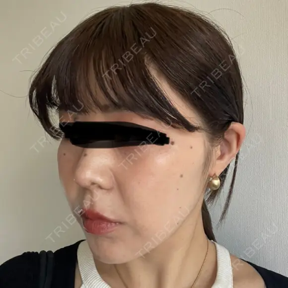 鼻尖形成（切開） / 小鼻縮小（切開） / 軟骨移植 ASTRA BEAUTY CLINIC DAY 19 メイン用