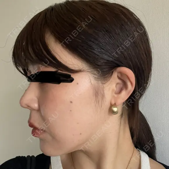 鼻尖形成（切開） / 小鼻縮小（切開） / 軟骨移植 ASTRA BEAUTY CLINIC DAY 19 メイン用