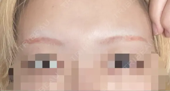 アートメイク除去・修正 表参道メディカルクリニック 新宿院 AFTER メイン用