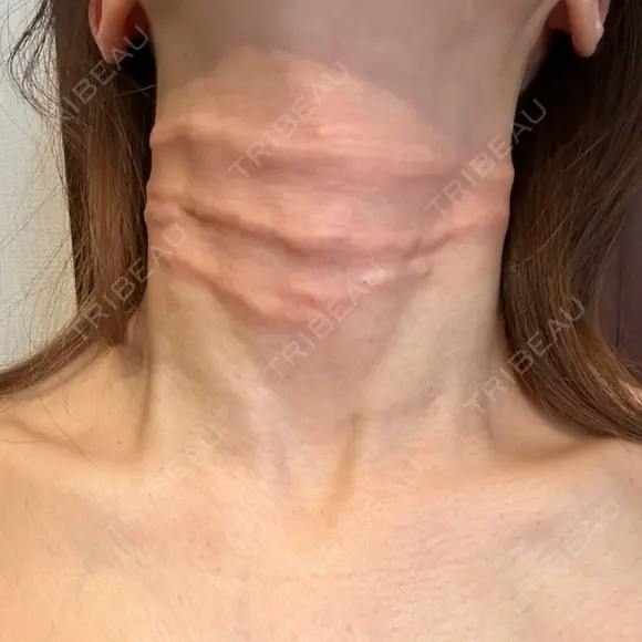 スネコス ミニマムスキンクリニック銀座 DAY 0 メイン用