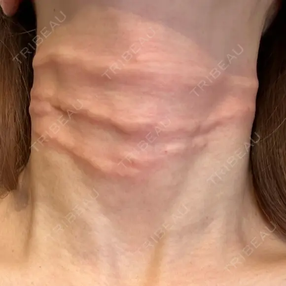 スネコス ミニマムスキンクリニック銀座 DAY 0 メイン用