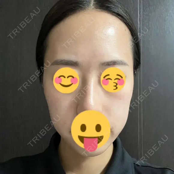 その他（肌） / ポテンツァ ゆう美容クリニック DAY 0 メイン用