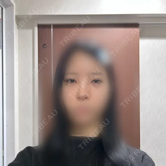 目頭切開 / 小鼻縮小（切開） / 鼻尖形成（非切開） アネシス美容クリニック DAY 18 メイン用