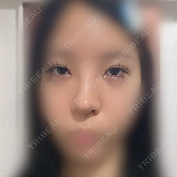 目頭切開 / 小鼻縮小（切開） / 鼻尖形成（非切開） アネシス美容クリニック DAY 18 メイン用