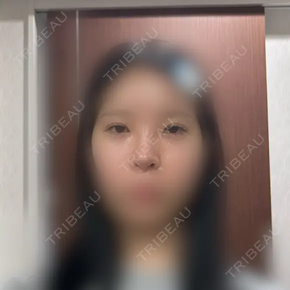 目頭切開 / 小鼻縮小（切開） / 鼻尖形成（非切開） アネシス美容クリニック DAY 35 メイン用