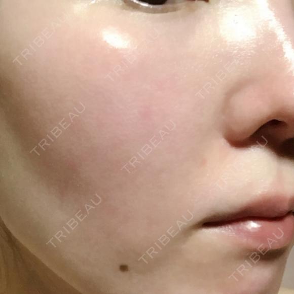 美肌レーザー みやた形成外科・皮ふクリニック DAY 12 メイン用