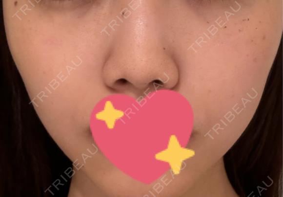 ルメッカ ルラ美容クリニック銀座院 DAY 5 メイン用