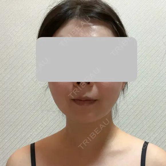 糸リフト / 脂肪吸引（顔） / 脂肪吸引（二の腕） / 脂肪注入（額） 脂肪吸引ラボトウキョウ AFTER メイン用