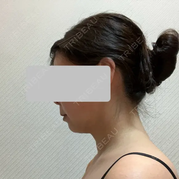 糸リフト / 脂肪吸引（顔） / 脂肪吸引（二の腕） / 脂肪注入（額） 脂肪吸引ラボトウキョウ DAY 25 メイン用