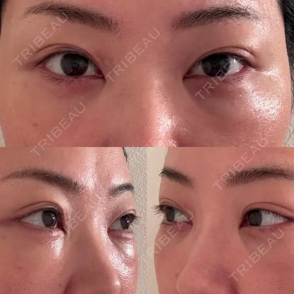 クマ治療 EMMO FACE CLINIC 東京三田院 DAY 7 メイン用