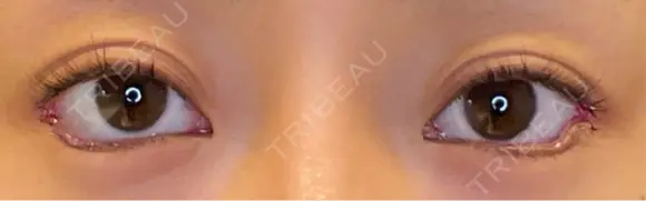 目頭切開 / タレ目形成・グラマラスライン（埋没） LOUIS CLINIC 二子玉川院【ルイクリニック】 DAY 0 メイン用