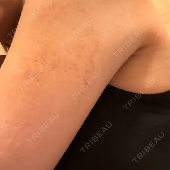 脂肪冷却（お腹） / 脂肪冷却（二の腕） DMTC CLINIC 日本橋院 AFTER メイン用