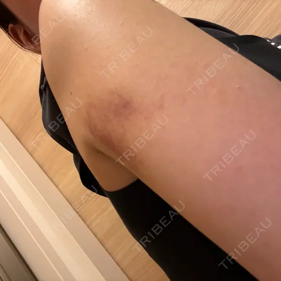 脂肪冷却（お腹） / 脂肪冷却（二の腕） DMTC CLINIC 日本橋院 DAY 4 メイン用