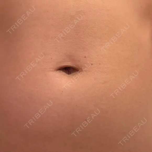 脂肪冷却（お腹） / 脂肪冷却（二の腕） DMTC CLINIC 日本橋院 DAY 4 メイン用