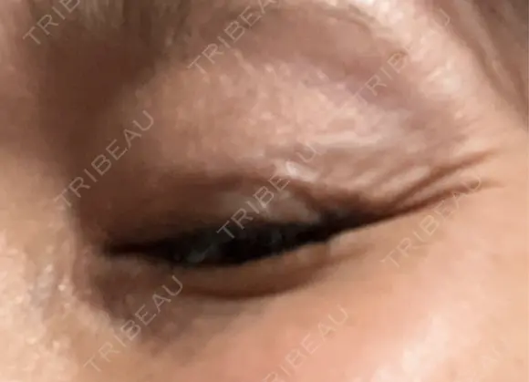 ボトックス（エラ・小顔） / ボトックス（目尻） / ボトックス（人中） 代々木駅前美容クリニック DAY 0 メイン用