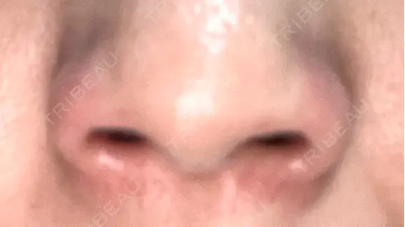 ボトックス（エラ・小顔） / ボトックス（目尻） / ボトックス（人中） 代々木駅前美容クリニック DAY 0 メイン用