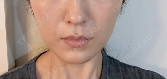 糸リフト 目白ホワイトクリニック DAY 1 メイン用