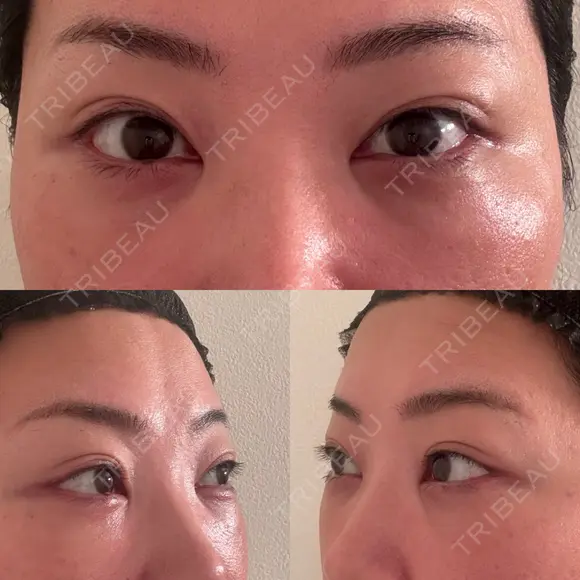 クマ治療 EMMO FACE CLINIC 東京三田院 DAY 8 メイン用