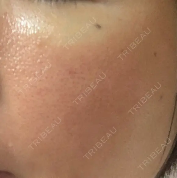 その他（肌） / ダーマペン スキンリファインクリニック銀座 DAY 2 メイン用