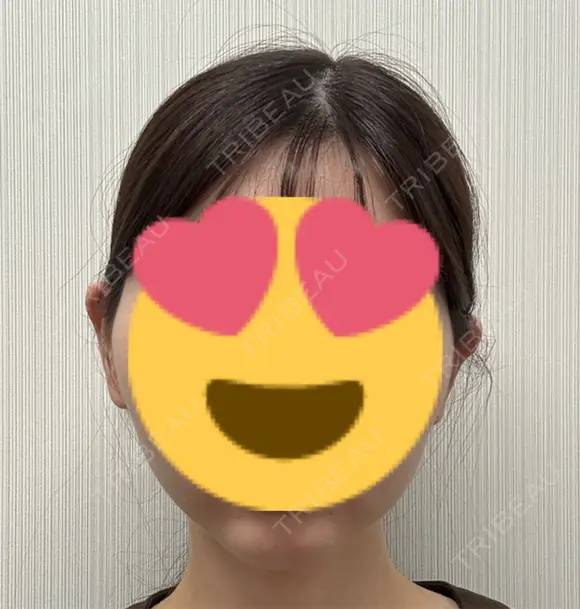 糸リフト / 脂肪吸引（顔） 脂肪吸引ラボトウキョウ AFTER メイン用