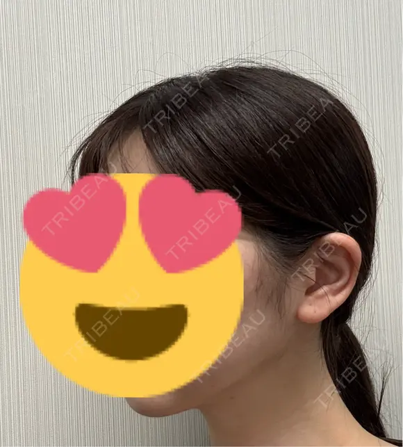 糸リフト / 脂肪吸引（顔） 脂肪吸引ラボトウキョウ DAY 92 メイン用