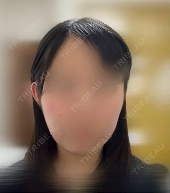 その他（肌） / サーマクール / RF（高周波）たるみ治療 ゆきスキンクリニック 東池袋 AFTER メイン用