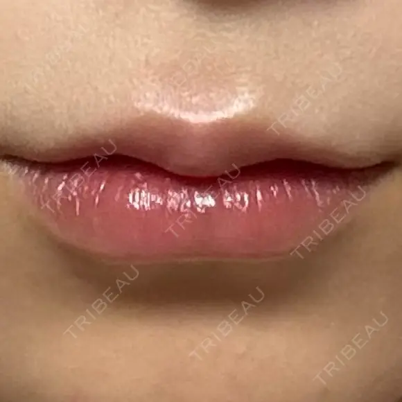 ヒアルロン酸注入（唇） AZ BEAUTY CLINIC DAY 0 メイン用