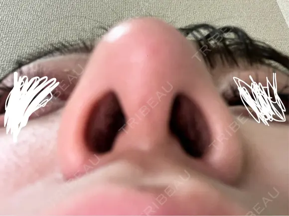 鼻尖形成（切開） / 小鼻縮小（切開） / 軟骨移植 / 鼻尖縮小 東京シンデレラ美容外科 新宿院 DAY 90 メイン用