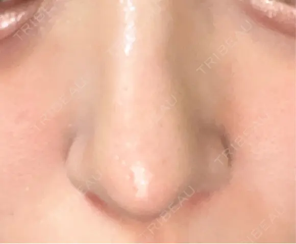 鼻尖形成（切開） / 小鼻縮小（切開） / 軟骨移植 / 鼻尖縮小 東京シンデレラ美容外科 新宿院 DAY 90 メイン用