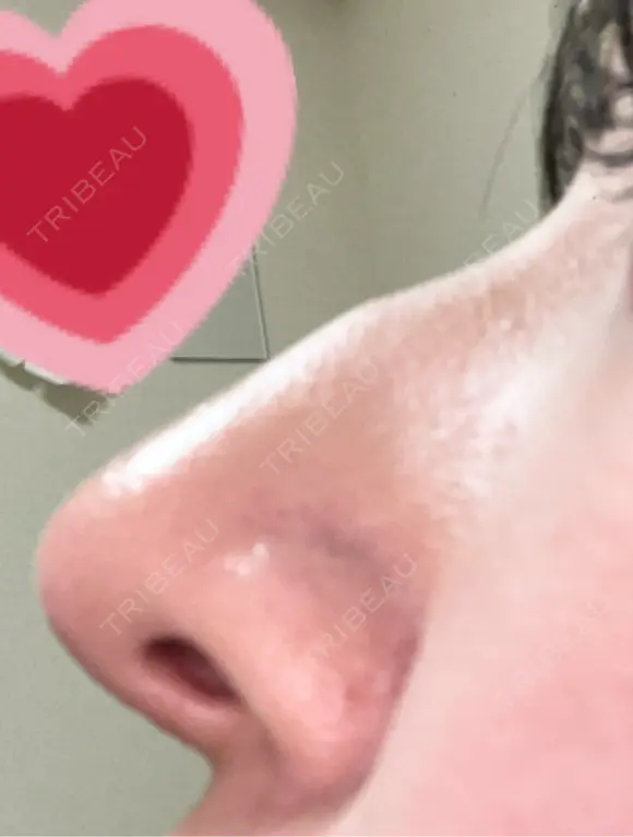 鼻尖形成（切開） / 小鼻縮小（切開） / 軟骨移植 / 鼻尖縮小 東京シンデレラ美容外科 新宿院 DAY 90 メイン用