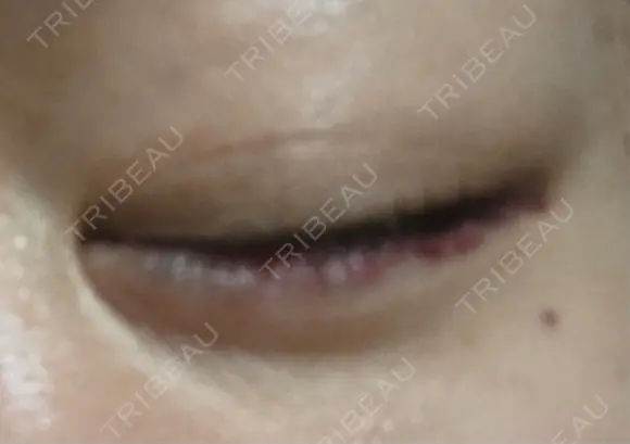 ヒアルロン酸注入（涙袋） アネシス美容クリニック DAY 2 メイン用