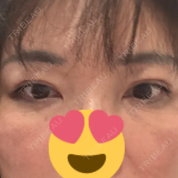 二重埋没 / 目元修正 BELINDA CLINIC（ベリンダクリニック）岡山院 DAY 34 メイン用