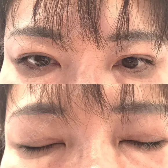 二重埋没 / 目元修正 BELINDA CLINIC（ベリンダクリニック）岡山院 DAY 34 メイン用