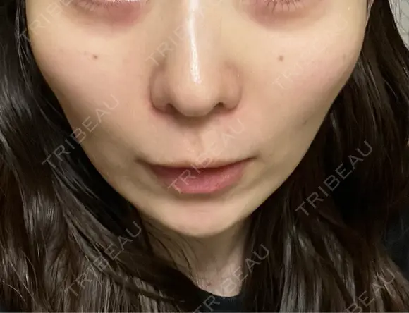 美肌レーザー まゆりなclinic 名古屋栄 DAY 3 メイン用