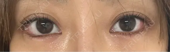 目頭切開 / タレ目形成・グラマラスライン（埋没） LOUIS CLINIC 二子玉川院【ルイクリニック】 DAY 1 メイン用