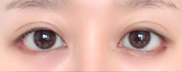 目尻切開 / 目尻靭帯移動 FROM B整形外科 (旧バウム整形外科) AFTER メイン用