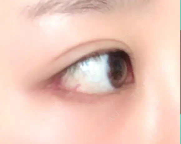 目尻切開 / 目尻靭帯移動 FROM B整形外科 (旧バウム整形外科) DAY 31 メイン用