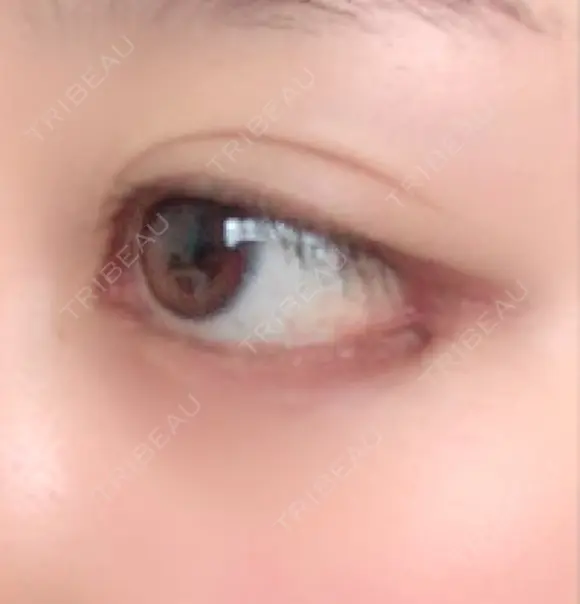 目尻切開 / 目尻靭帯移動 FROM B整形外科 (旧バウム整形外科) DAY 31 メイン用