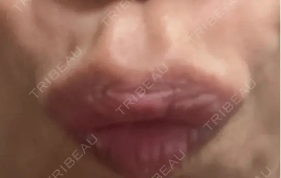 ボトックス（エラ・小顔） / ボトックス（目尻） / ボトックス（人中） 代々木駅前美容クリニック DAY 2 メイン用