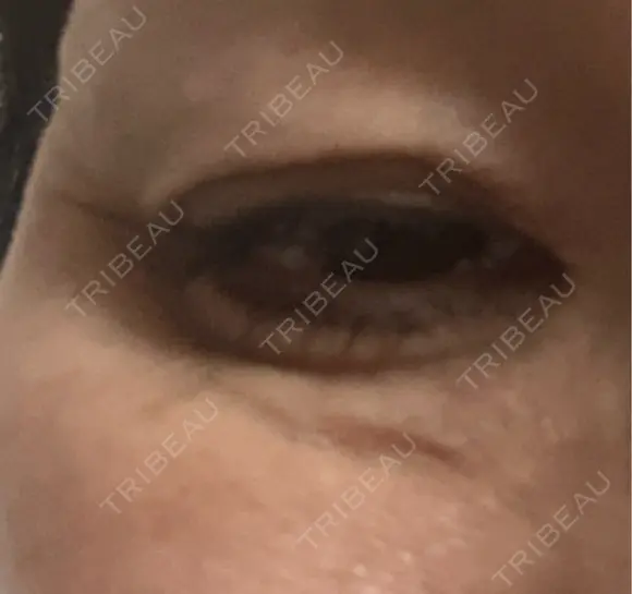 ボトックス（エラ・小顔） / ボトックス（目尻） / ボトックス（人中） 代々木駅前美容クリニック DAY 2 メイン用