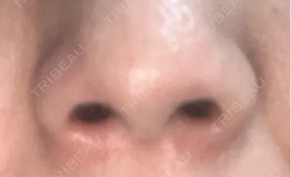 ボトックス（エラ・小顔） / ボトックス（目尻） / ボトックス（人中） 代々木駅前美容クリニック DAY 2 メイン用