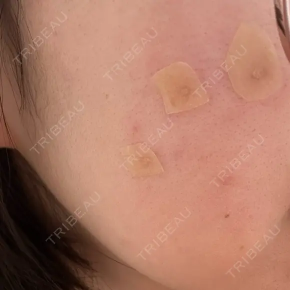 ほくろ・いぼ除去レーザー（肌） Fellez Clinic【フェルズクリニック】 AFTER メイン用