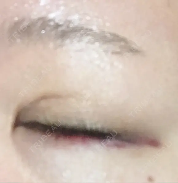 ヒアルロン酸注入（涙袋） アネシス美容クリニック DAY 3 メイン用