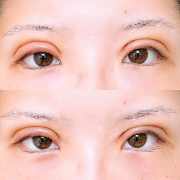 二重切開 アネシス美容クリニック DAY 3 メイン用