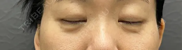 クマ治療 渋谷の森クリニック DAY 35 メイン用