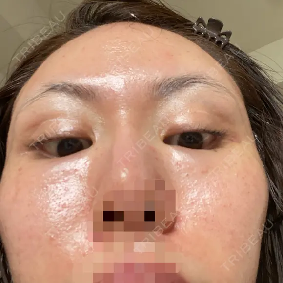 水光注射（ハリ・美肌） / リジュラン 湘南美容クリニック 池袋西口院 DAY 0 メイン用