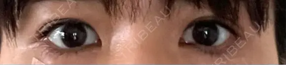 タレ目形成・グラマラスライン（埋没） LOUIS CLINIC 二子玉川院【ルイクリニック】 AFTER メイン用