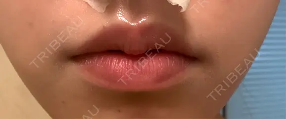 ボトックス（口角） / ボトックス（肩） DMTC CLINIC 日本橋院 DAY 2 メイン用