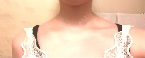 ボトックス（口角） / ボトックス（肩） DMTC CLINIC 日本橋院 DAY 2 メイン用