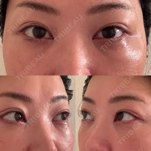 クマ治療 EMMO FACE CLINIC 東京三田院 DAY 11 メイン用